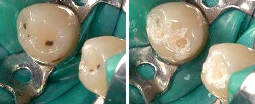 Carious Dentine Removal Courtesy of: Ivica Anić, DDS, Ph.D. Laser source: Er:YAG (2940 nm)