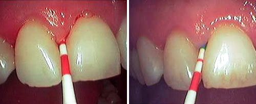 Closed Curettage Courtesy of: Paolo Calvani, DDS Laser source: Nd:YAG (1064 nm)