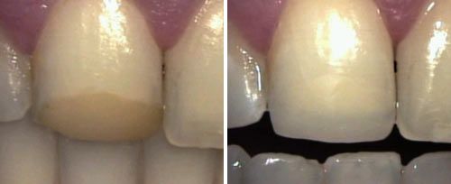 Composite Material Removal Courtesy of: Augusto Baldissarri, DDS Laser source: Er:YAG (2940 nm)