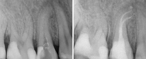 Endodontic Treatment Courtesy of: Dr. Ralf Schlichting Laser source: Er:YAG (2940 nm)