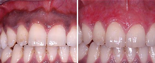 Gum Pigmentation Removal Courtesy of: Ilay Maden Ph.D., M.Sc. Laser source: Er:YAG (2940 nm)