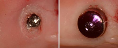 Implant Release Courtesy of: Assist. Prof. Dragana Gabric, DMD, PhD Laser source: Er:YAG (2940 nm)