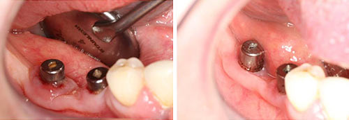 Peri-implant Mucositis Courtesy of: Bogdan Crisan, DMD, PhD Laser source: TwinLight®: Nd:YAG (1064 nm) + Er:YAG (2940 nm)
