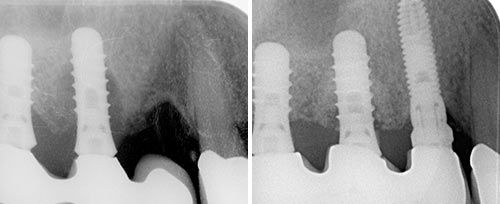 Peri-implantitis Courtesy of: Aslan Gokbuget, DDS, PhD Laser source: TwinLight®: Nd:YAG (1064 nm) + Er:YAG (2940 nm)