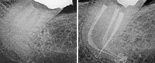 Endodontic Treatment Courtesy of: Enrico DiVito, DDS Laser source: Er:YAG (2940 nm)
