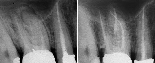 Endodontic Treatment Courtesy of: Giovanni Olivi, MD, DDS Laser source: Er:YAG (2940 nm)