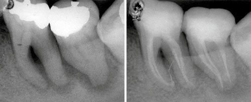 Endodontic Treatment Courtesy of: Giovanni Olivi, MD, DDS Laser source: Er:YAG (2940 nm)