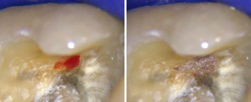 Pulp Capping Courtesy of: Giovanni Olivi, MD, DDS Laser source: Er:YAG (2940 nm)