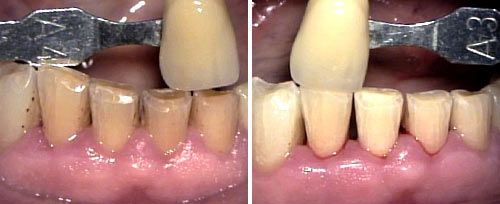 Tooth Whitening Courtesy of: Augusto Baldissarri, DDS Laser source: Nd:YAG (1064 nm)