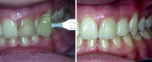 Tooth Whitening Courtesy of: Carlo Fornaini, MD, DDS, M.Sc. Laser source: Nd:YAG (1064 nm)