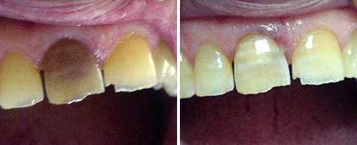 Tooth Whitening Courtesy of: Jugoslav Jovanovic, DDS Laser source: Er:YAG (2940 nm)