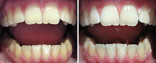 Tooth Whitening Courtesy of: Evgeniy Mironov, DDS Laser source: Er:YAG (2940 nm)