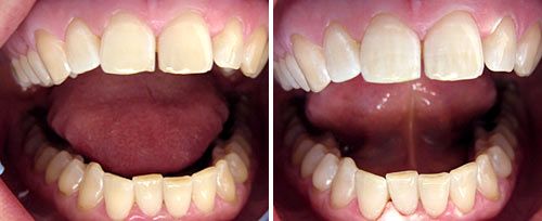 Tooth Whitening Courtesy of: Evgeniy Mironov, DDS Laser source: Er:YAG (2940 nm)